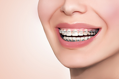 Ask Your North Houston and East Texas Dentist: Should I Get Metal or Clear  Braces?, Element Dental & Orthodontics