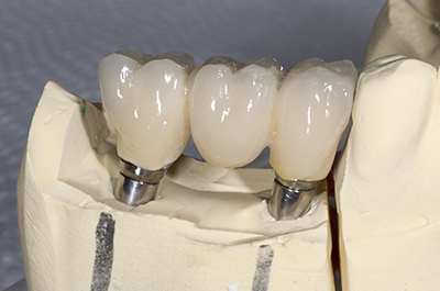 dental-implants